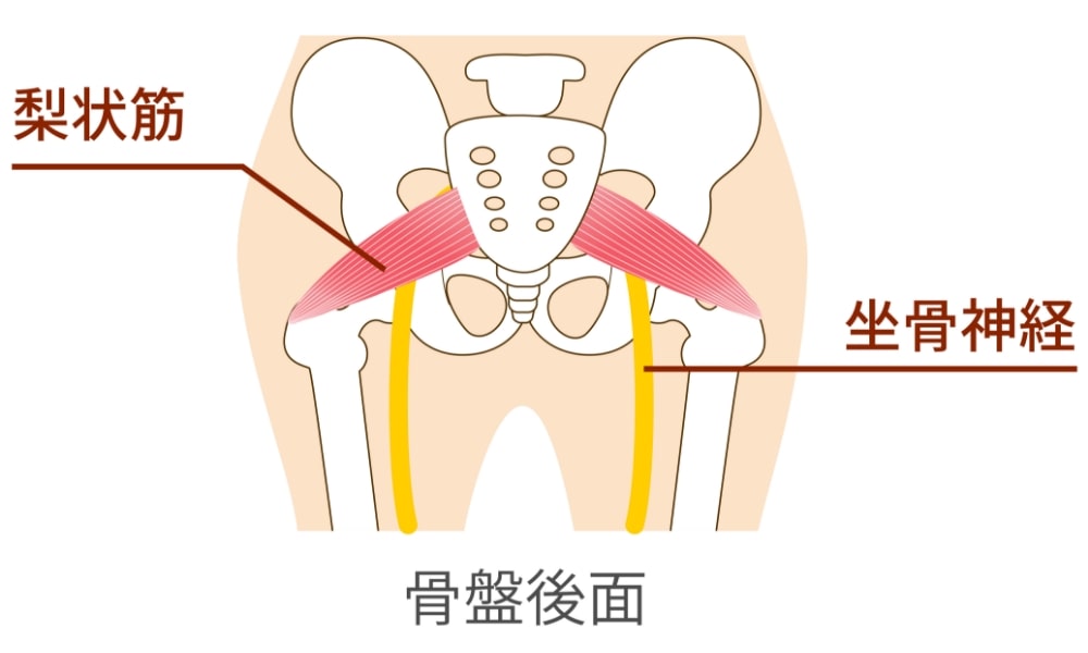 梨状筋症候群のイラスト