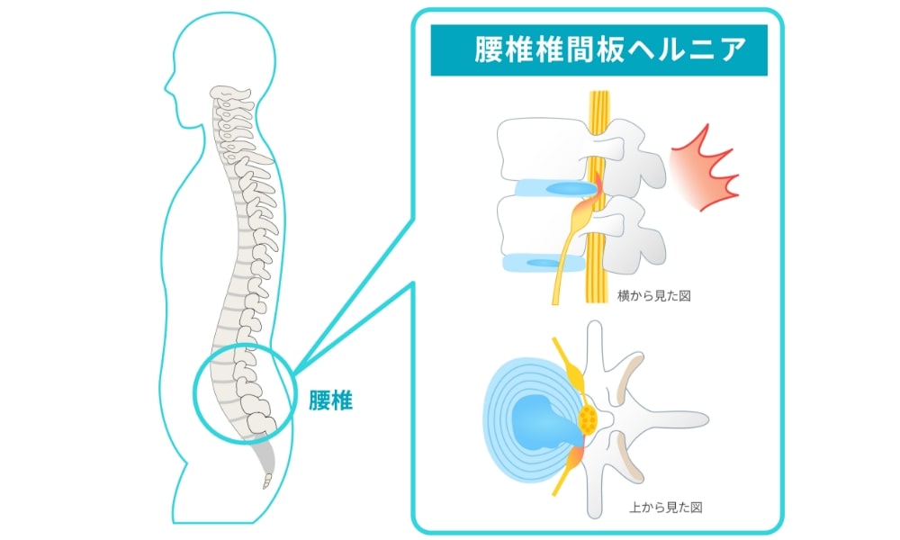 腰椎椎間板ヘルニアのしくみ