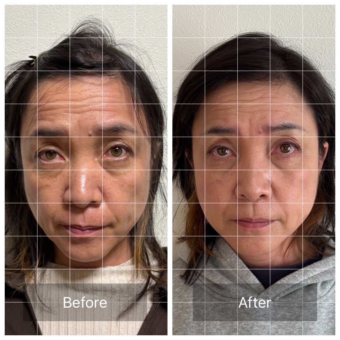 美容鍼のビフォーアフター